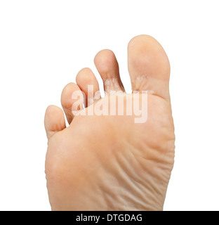 Einen Fuß auf einem weißen Hintergrund, Fußpilz, Tinea Pedis. Stockfoto