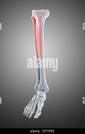 Medialen Tibia Stress-Syndrom Stockfoto