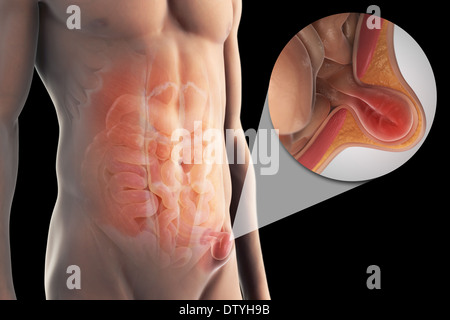 Leistenbruch Stockfoto