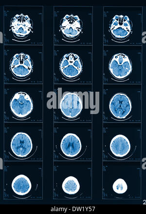 Röntgen-Computertomographie Stockfoto