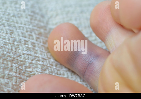 Verstauchten Fuß, linker Fuß Stockfoto