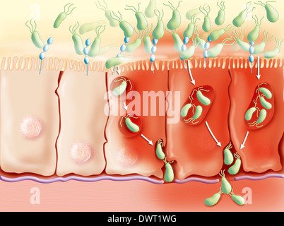 Morbus Crohn, Zeichnung Stockfoto