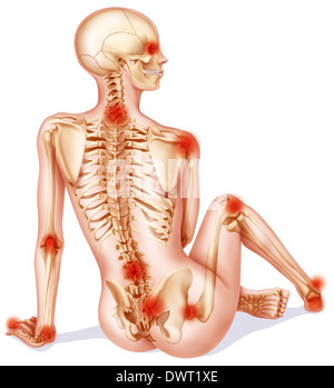 Spondylarthritis Zeichnung Stockfoto