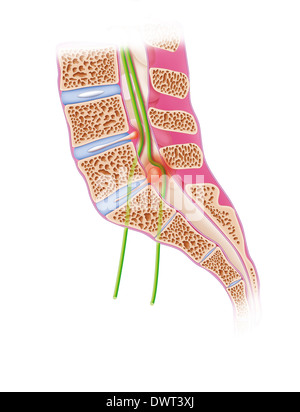 Ischias, Zeichnung Stockfoto