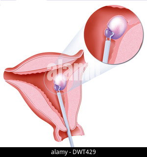 Myomektomie Zeichnung Stockfoto