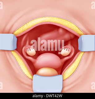 Hysterektomie zeichnen Stockfoto