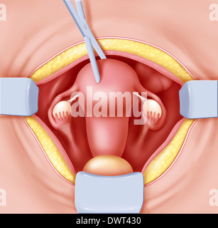 Hysterektomie zeichnen Stockfoto