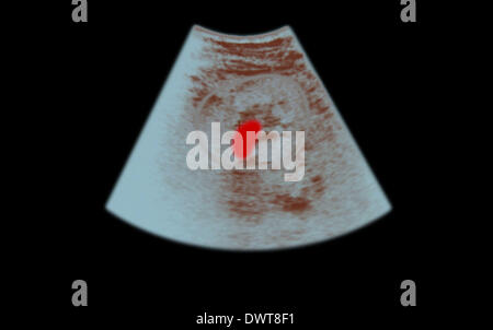 Ultraschalluntersuchung der Nieren-Stein Stockfoto