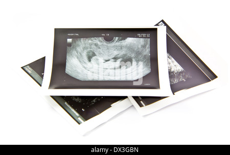 12 Wochen Baby Ultraschall Bild Stockfoto