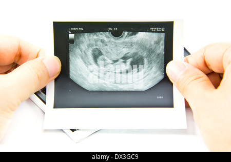 12 Wochen Baby Ultraschall Bild Stockfoto