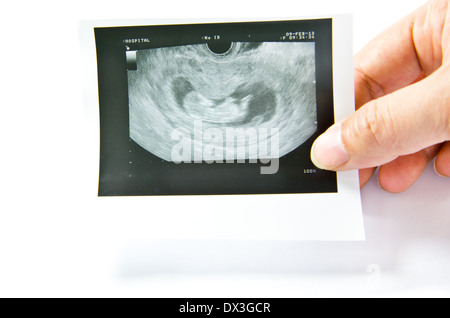 12 Wochen Baby Ultraschall Bild Stockfoto