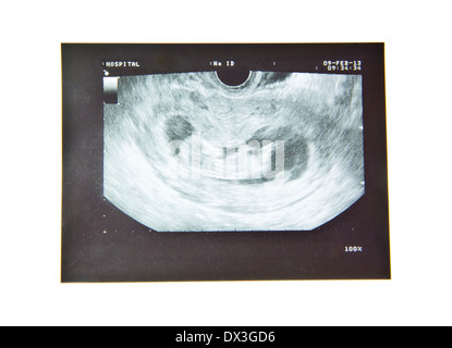 12 Wochen Baby Ultraschall Bild Stockfoto