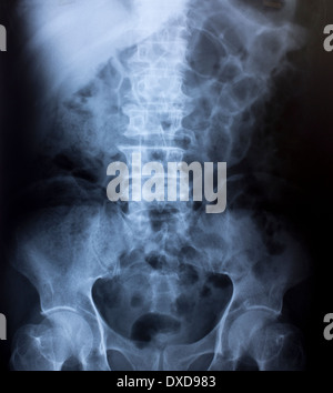 Röntgen-Bild der menschlichen Brust für eine medizinische Diagnose Stockfoto