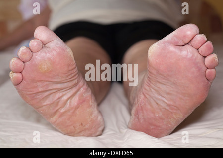 Detail des Kranken senior weiblichen geschwollene Beine mit beschädigten Zehen und Nägel. Stockfoto