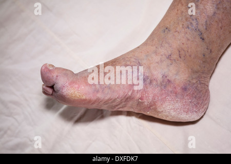 Detail des Kranken senior weibliche geschwollene Bein mit beschädigten Zehen und Nägel. Stockfoto