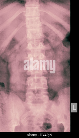 X-ray Kompressionsfraktur L2 Wirbel der 14 Jahre alt Männlich, front Ansicht Stockfoto