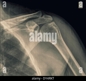 Röntgen der Schulter eines 40 Jahre alten männlichen Patienten mit gebrochenen Schlüsselbein-Vorderansicht Stockfoto
