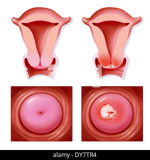 Gebärmutterhalskrebs, Zeichnung Stockfoto