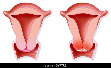Gebärmutterhalskrebs, Zeichnung Stockfoto