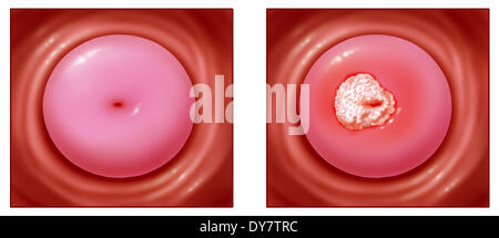 Gebärmutterhalskrebs, Zeichnung Stockfoto