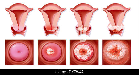 Gebärmutterhalskrebs, Zeichnung Stockfoto