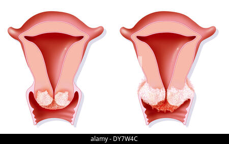 Gebärmutterhalskrebs, Zeichnung Stockfoto