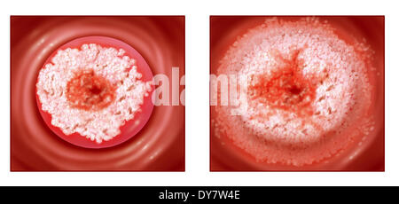 Gebärmutterhalskrebs, Zeichnung Stockfoto