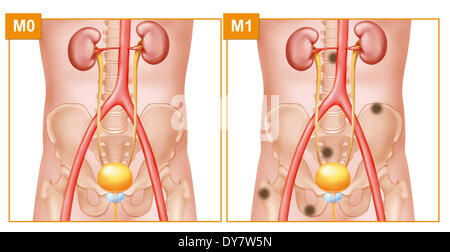 Metastasen, Zeichnung Stockfoto