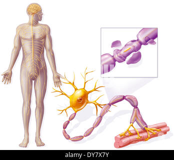 Multiple Sklerose Stockfoto