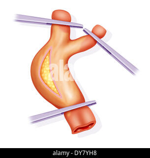 Endarteriectomy, Zeichnung Stockfoto