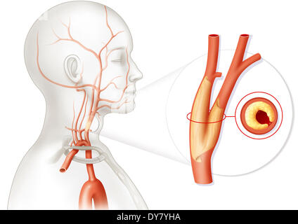 Stenose der a. carotis, Zeichnung Stockfoto