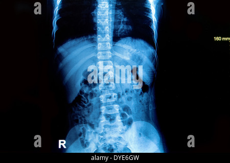 x-ray Bild Wirbelsäule und des Beckens eines menschlichen Körpers Stockfoto