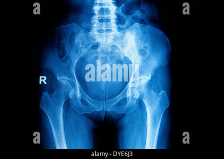 X-ray Bild Becken und Hüfte einer Frau Stockfoto