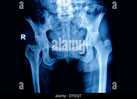 X-ray Bild Becken und Hüfte einer Frau Stockfoto