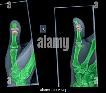 Röntgenbild eines Daumens mit einer gebrochenen distalen phalanx Stockfoto