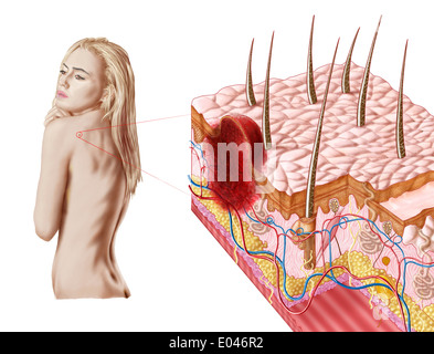 Abbildung eines atypischen Wachstums auf der Haut, die Anzeichen von Hautkrebs sein kann. Stockfoto