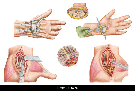 Medizinische Illustration zeigt Karpaltunnel-Syndrom in der menschlichen Handgelenk und den chirurgischen Eingriffen zugeordnet. Stockfoto