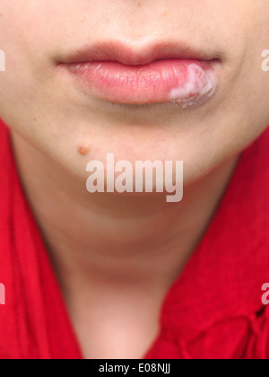 Junge Frau mit Salbe auf Lippe wegen Herpes simplex Stockfoto