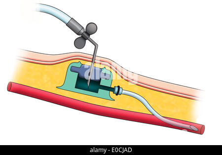 Venösen Zugang port Stockfoto