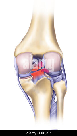 Geplatzten Knie Bänder Stockfoto