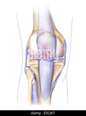 Geplatzten Knie Bänder Stockfoto