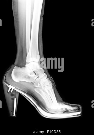 Röntgen von einem Fuß- und Sprunggelenk in einem high-Heel-Schuh Stockfoto