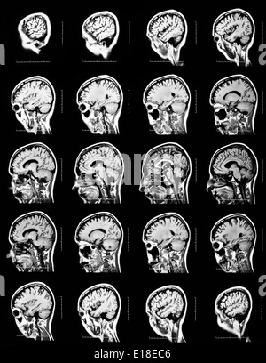 Reihenfolge der vertikalen Abschnitte des menschlichen Gehirns - MRT-Untersuchung Stockfoto