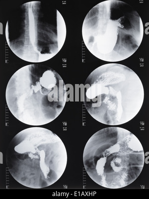 Magnet-Resonanz-Tomographie des Magens und des Darms Stockfoto