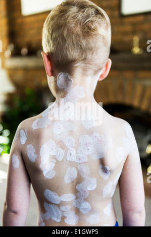 Ein fünf Jahre alter Junge für Windpocken behandelt. Stockfoto