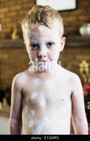 Ein fünf Jahre alter Junge für Windpocken behandelt. Stockfoto