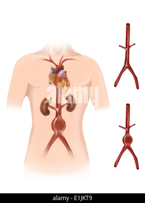 Künstler Depcition der abdominalen Aortenaneurysma. Stockfoto