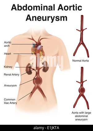 Künstler Depcition der abdominalen Aorta Aneuryism (mit Aufklebern). Stockfoto