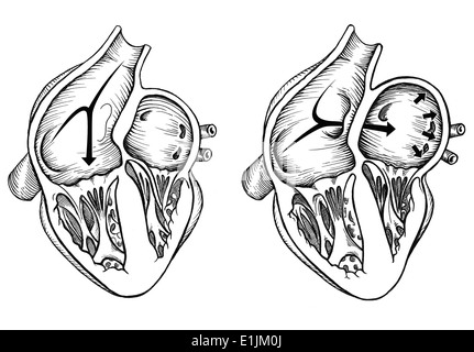 Vergleich der normalen Herz gegen Herz mit einem patent Foramen Ovale. Stockfoto