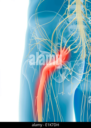 Entzündeten Ischiasnerv Computer Artwork. Stockfoto